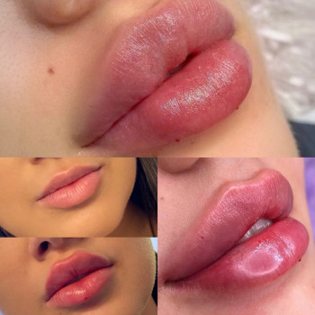 Аугументация губ
                    Косметолог-ін'єкціоніст Ирина Херсон