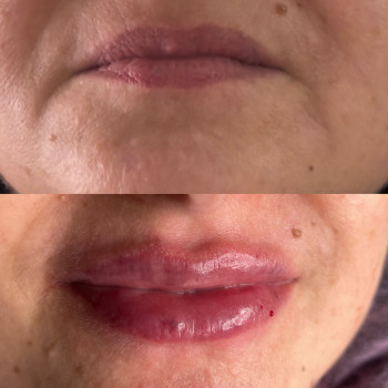 Аугументация губ
                    Косметолог-ін'єкціоніст Ирина Херсон