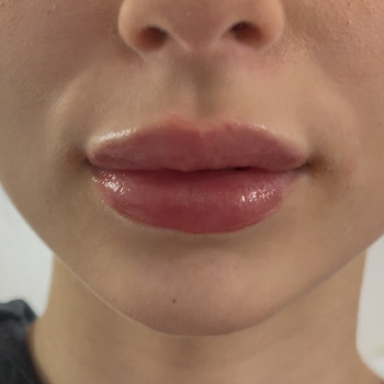 Аугументация губ
                    Косметолог-ін'єкціоніст Ирина Херсон