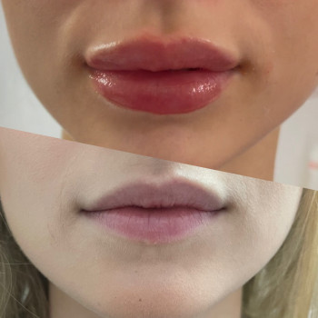 Аугументация губ
                    Косметолог-ін'єкціоніст Ирина Херсон