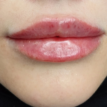 2мл філлера