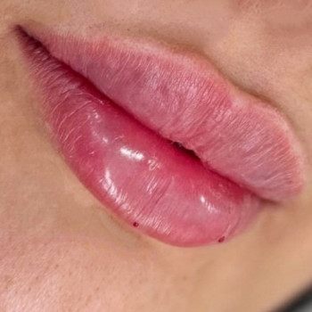 1мл філлера