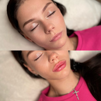 Збільшення губ 1 мл

   