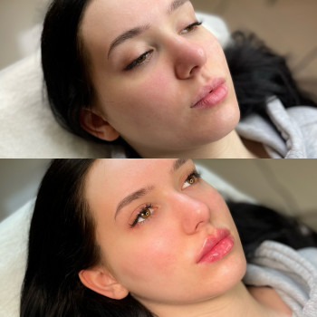 Збільшення губ 1 мл

   