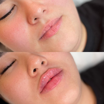 Контурна пластика губ 1 мл

   