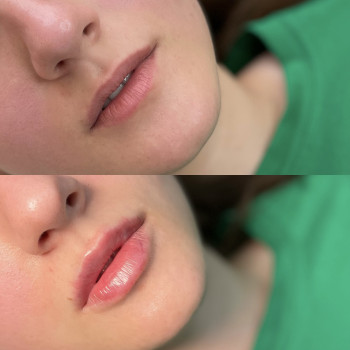 Збільшення губ 1 мл

   