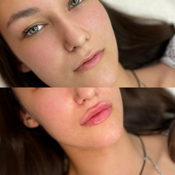 Збільшення губ 1 мл