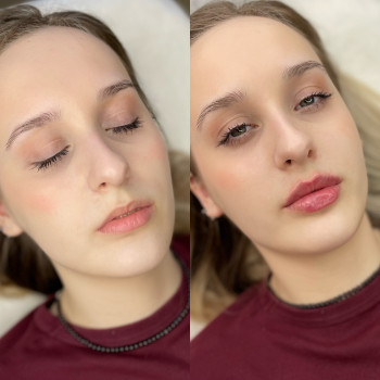 Збільшення губ 1 мл