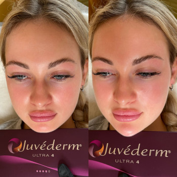 Контурна пластика підборіддя Ужгород

   