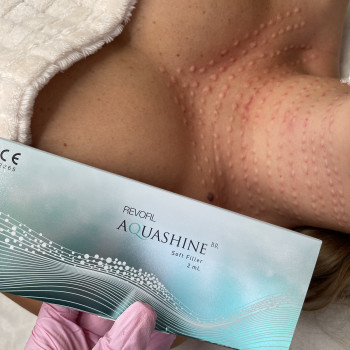 Робота з якістю шкіри шиї ( Aquashine препарат на основі пептидів та ГК)



   