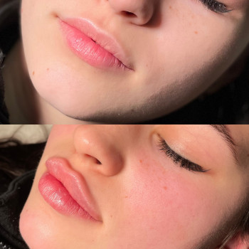 Збільшення губ Ужгород

  