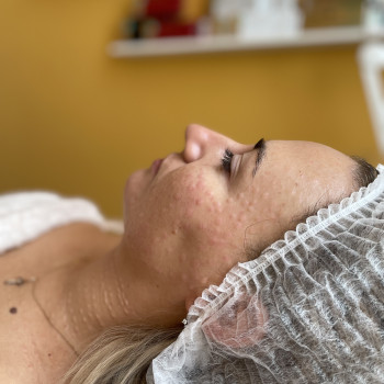 Біоревіталізація зони обличчя



   