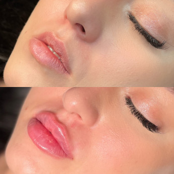 Збільшення губ



   