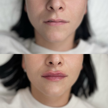 Збільшення губ Ужгород



   