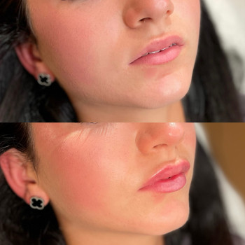 Збільшення губ



   