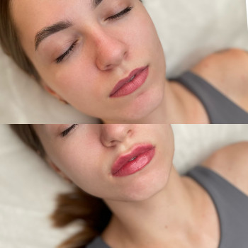 Збільшення губ