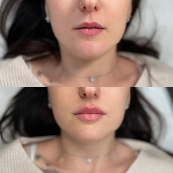 Збільшення губ 

  