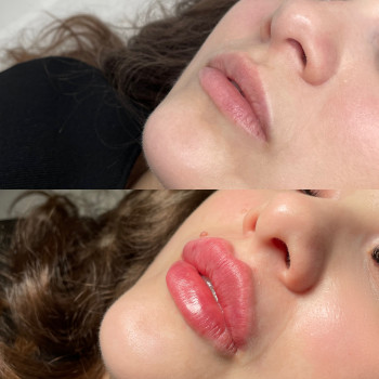 Збільшення губ Ужгород
   