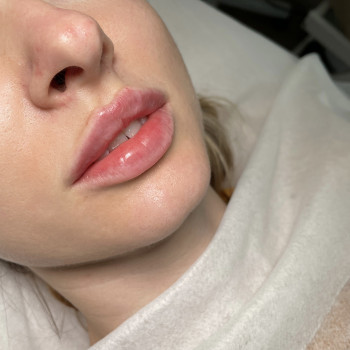 Збільшення губ

   