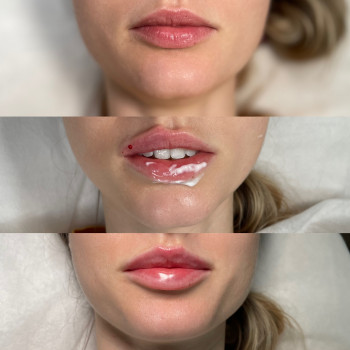 Збільшення губ



   