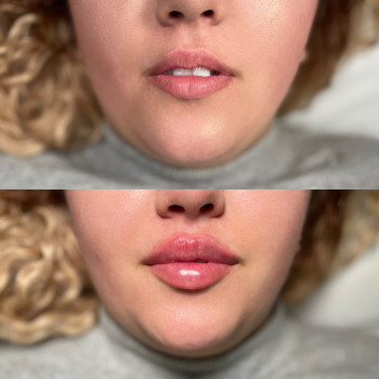 Збільшення губ Ужгород 



   