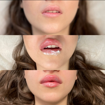 Збільшення губ Ужгород



   