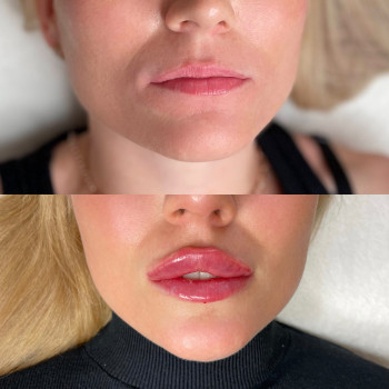 Збільшення губ Revolax Deep 



   