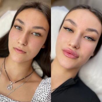 Збільшення губ до / після



   