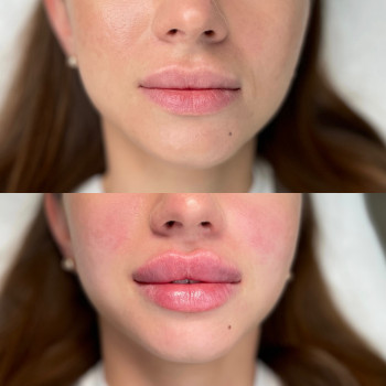 Збільшення губ результат до / після



   