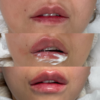 Процес корекції губ



   