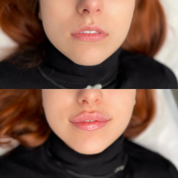 Збільшення губ



   