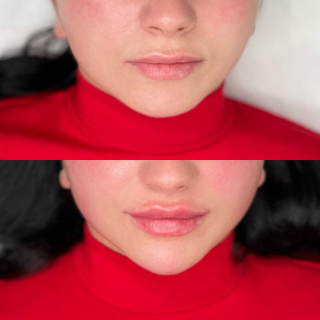 Комплексна робота збільшення губ + контурна пластика підборіддя



   