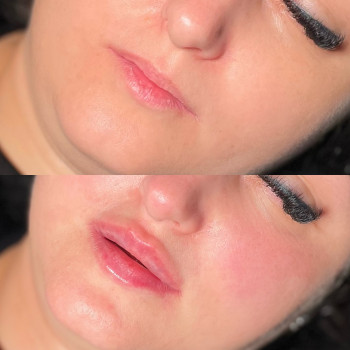 Збільшення губ



   