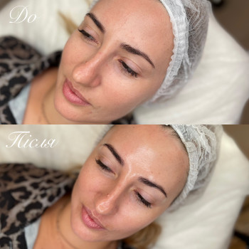 Результат після процедури «Миттєвий ліфтинг»



   