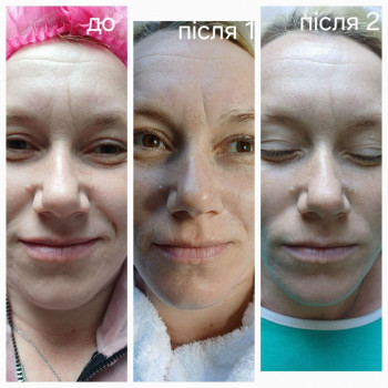 Карбоксітерапія
                    Косметолог Мар'яна Трускавец