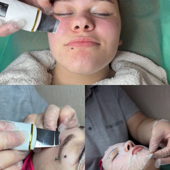 Ультразвукове очищення шкіри
                    Косметолог Юлия Черкассы