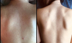 Комбинированая чистка спины Косметологічний центр Perfect Skin Київ