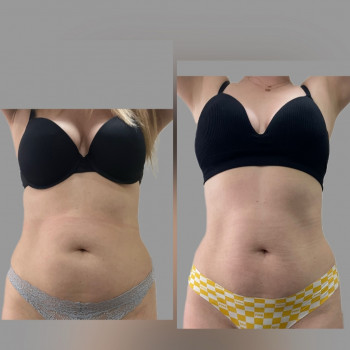 Кріоліполіз масаж з заморозкою жирової тканини
                    Реабілітолог Юлия Київ