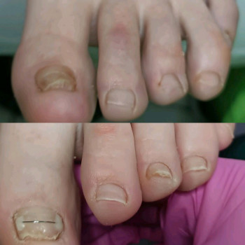 Корекція деформованого нігтя, результат за 3 місяців