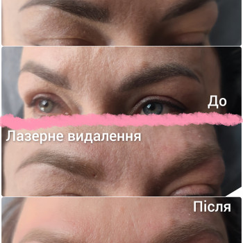 Видалення неякісного татуажу
                    Бровіст Вікторія Рівне