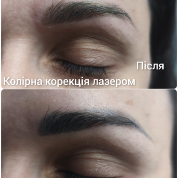 Видалення неякісного татуажу
                    Бровіст Вікторія Рівне