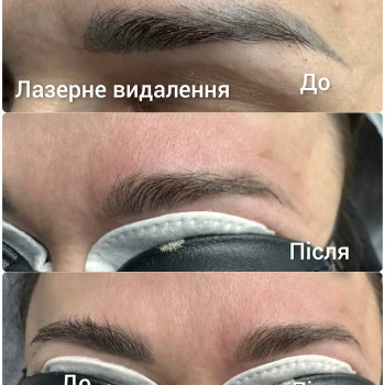 Видалення неякісного татуажу
                    Бровіст Вікторія Рівне