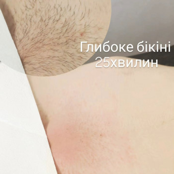  #елекроепіляціявінниця
 #ваксінг
 #шугаринг
 #депіляція
