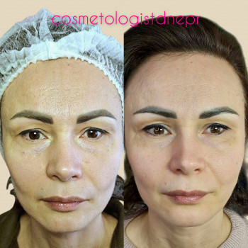 4 процедури