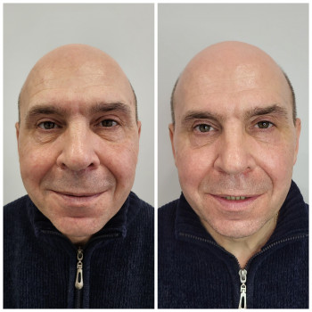 Ботулінотерапія Київ