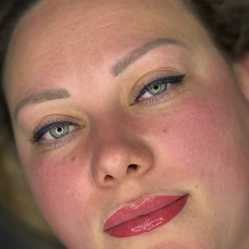 губи одразу після процедури, мінімальний набряк