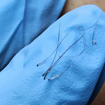 Електроепіляція
                    Электролог  Хмельницкий