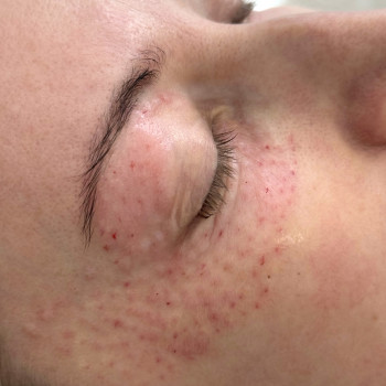 Біоревіталізація зони навколо очей