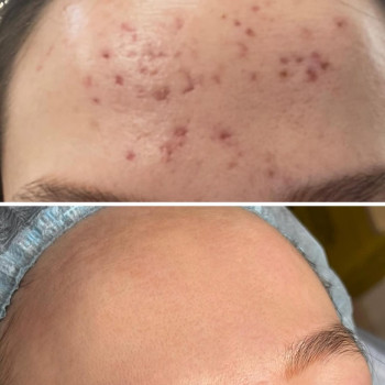 Результат роботи з рубцями постакне