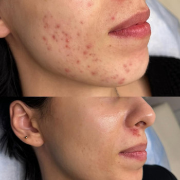 Результат роботи з рубцями постакне